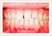 Catonsville, MD teeth whitening