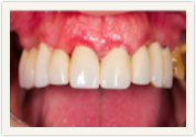 Catonsville Dental Center Dental bridges