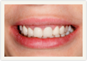 Catonsville Dental Center veneers