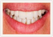 Catonsville Dental Center dental veneers